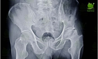 Avascular Necrosis Avascular Necrosis