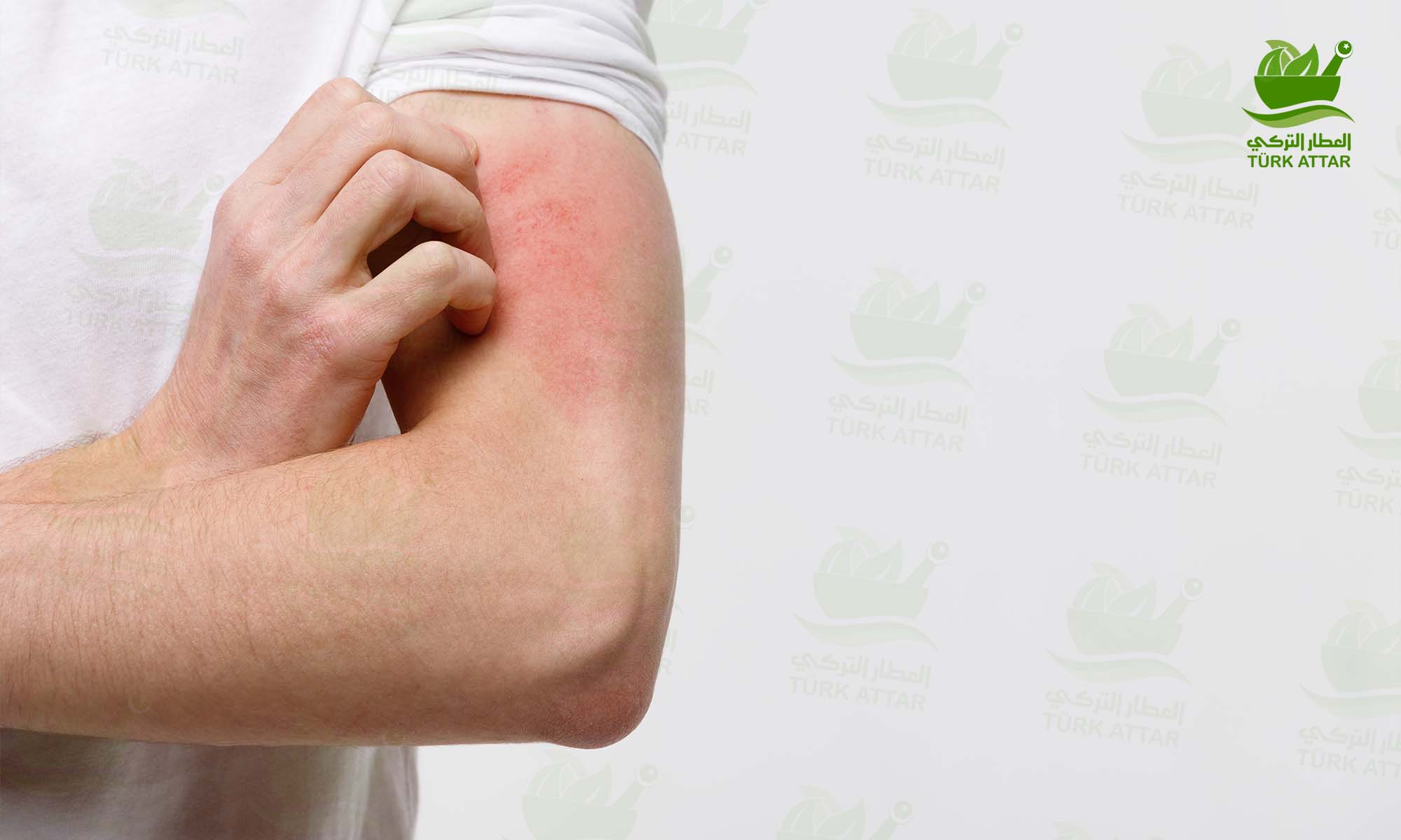 Chronic Hives Treatment