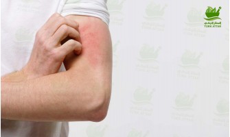 Chronic Hives Treatment Chronic Hives Treatment