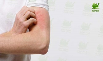 Chronic Hives Treatment