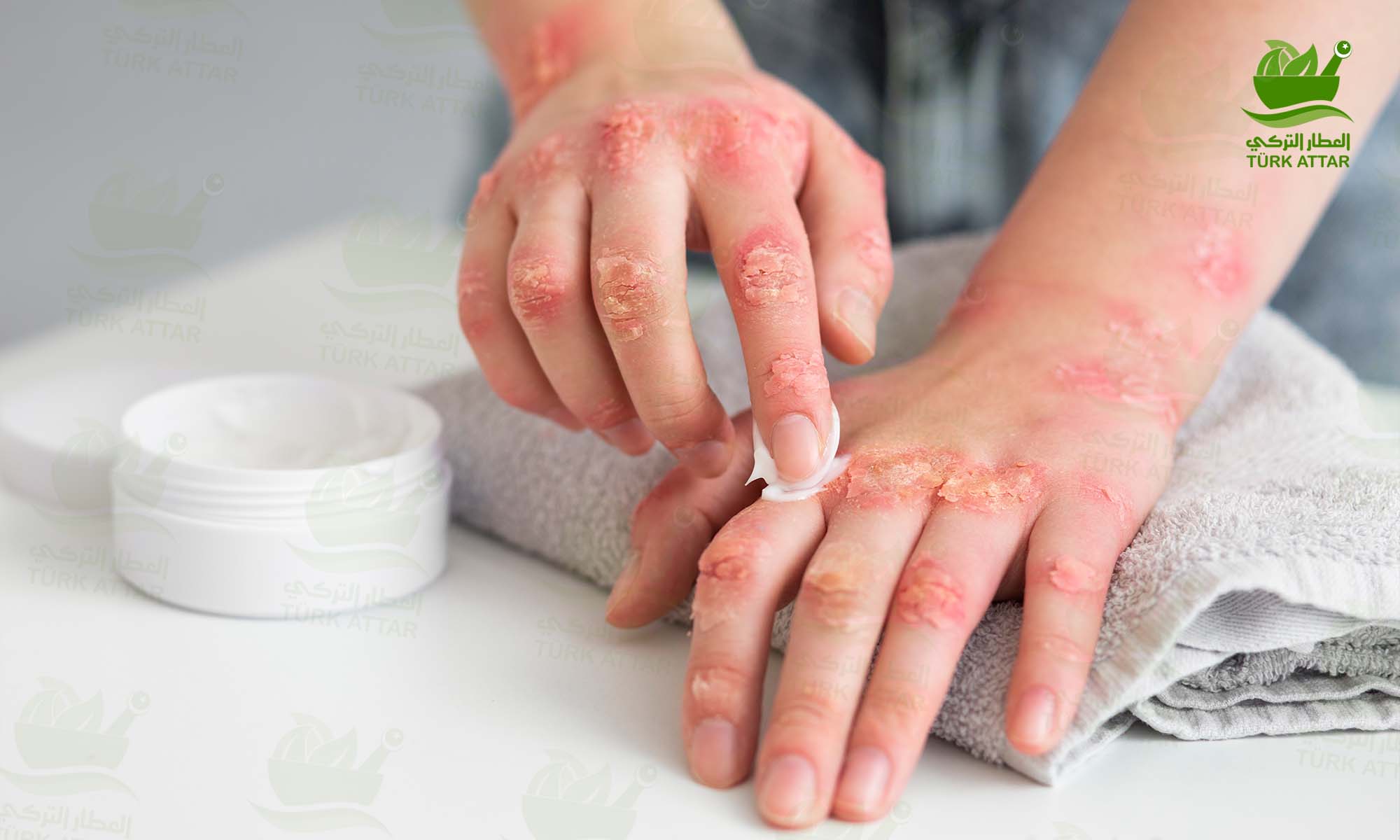 Psoriasis Treatment