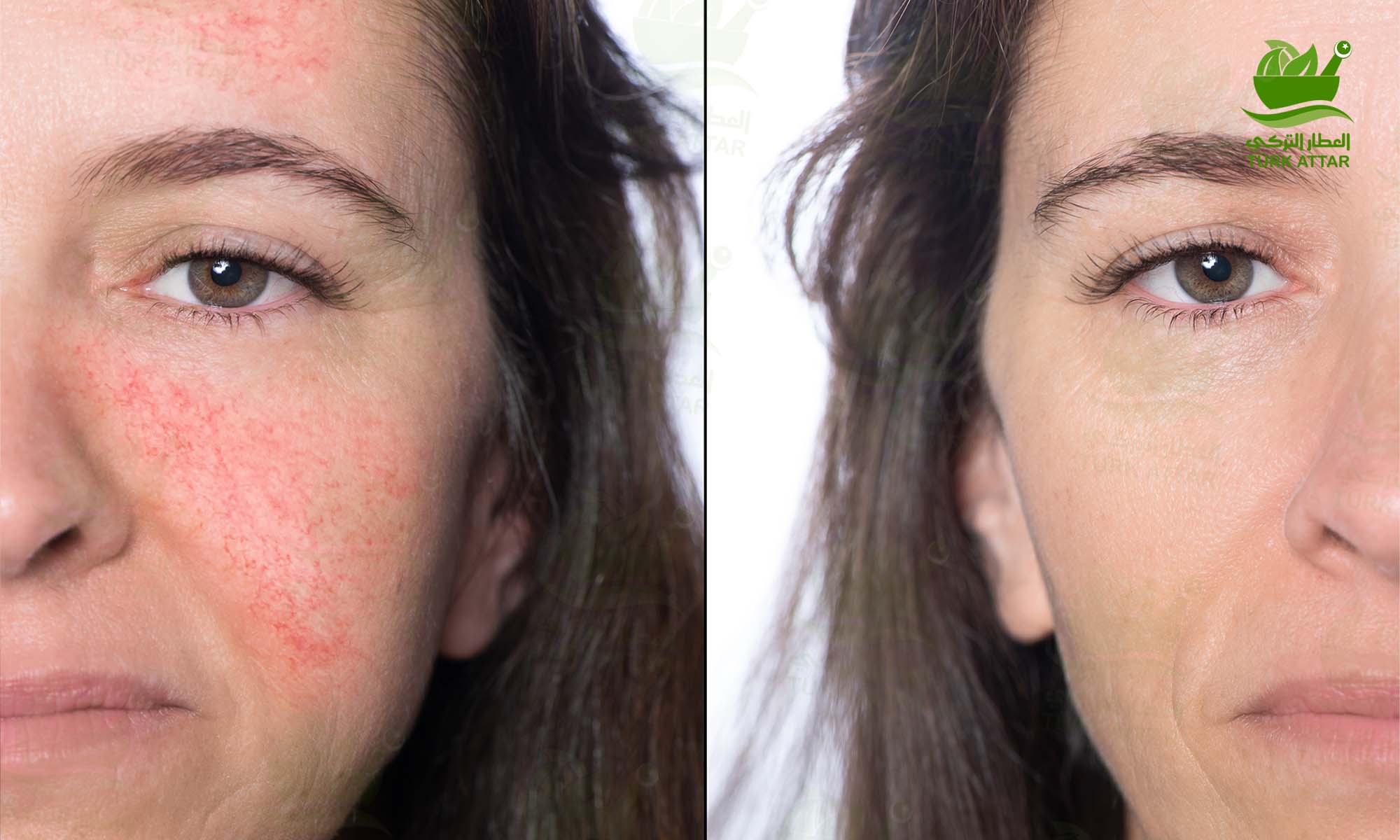 Rosacea Treatment