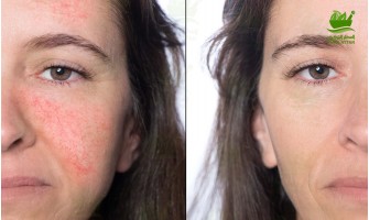 Rosacea Treatment Rosacea Treatment