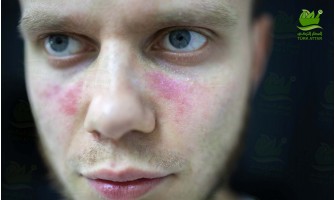 الذئبة الحمامية الجهازية الذئبة الحمامية الجهازية