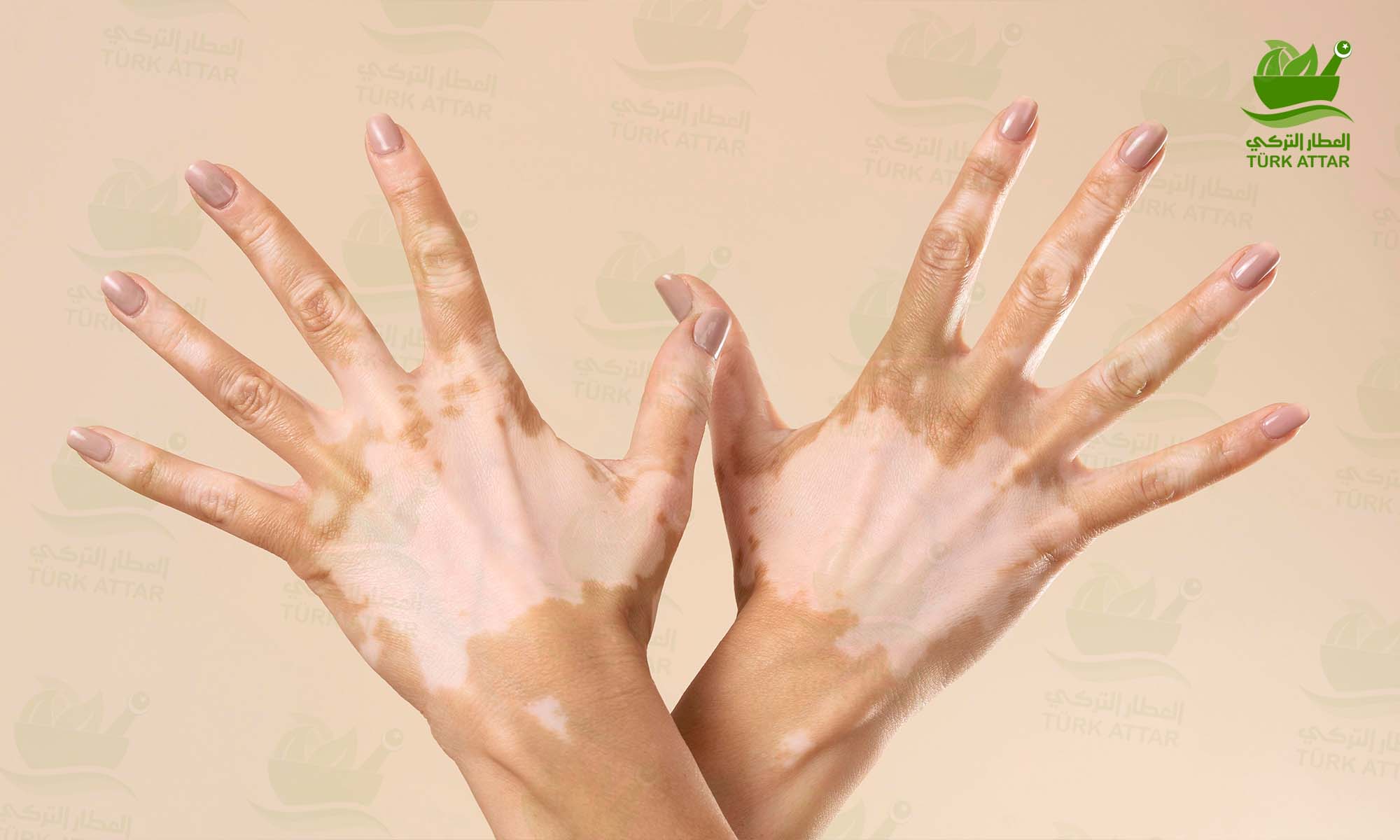 Vitiligo Treatment