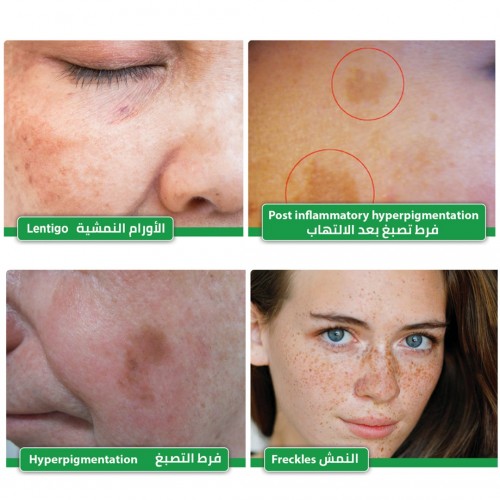 Melan IQ Hyperpigmentation Cream, Dark Spot Cream, Skin Spot Cream, Skin Whitening Cream, Pharmaceutical Cream, Revolutionary Formula of Plant Extract, Alpha Arbutin, Glabridin, 30ml Melan IQ Hyperpigmentation Cream, Dark Spot Cream, Skin Spot Cream, Skin Whitening Cream, Pharmaceutical Cream, Revolutionary Formula of Plant Extract, Alpha Arbutin, Glabridin, 30ml
